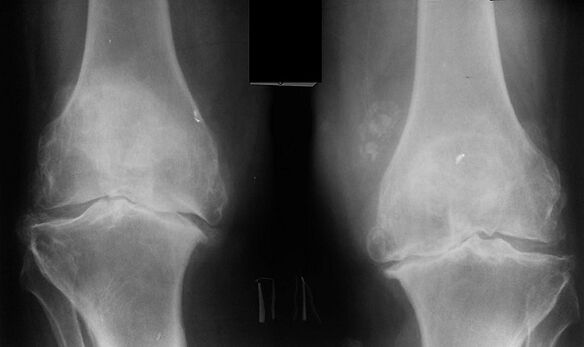 X -ray ως τρόπος διάγνωσης της αρθρίδας της άρθρωσης του γόνατος